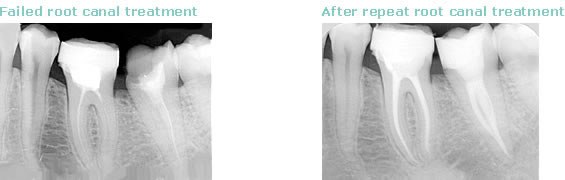 successful root canal treatment