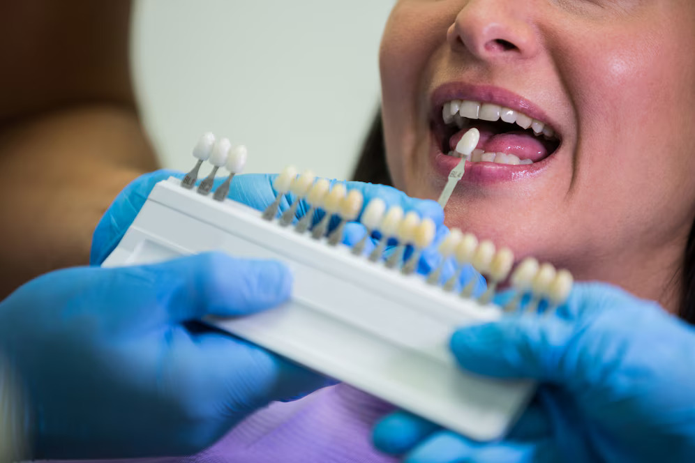 Dental Veneers – The Secret Behind a Confident, Camera-Ready Smile